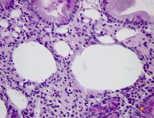 cured Whipple disease (HE) cured Whipple disease (HE)
